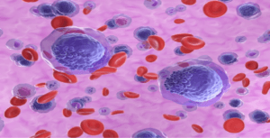 Orca-T Significantly Boosts Survival Over Cyclophosphamide in Transplant Study